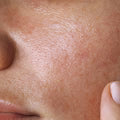 ⁠Oily Skin