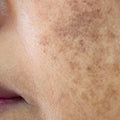 ⁠Pigmentation